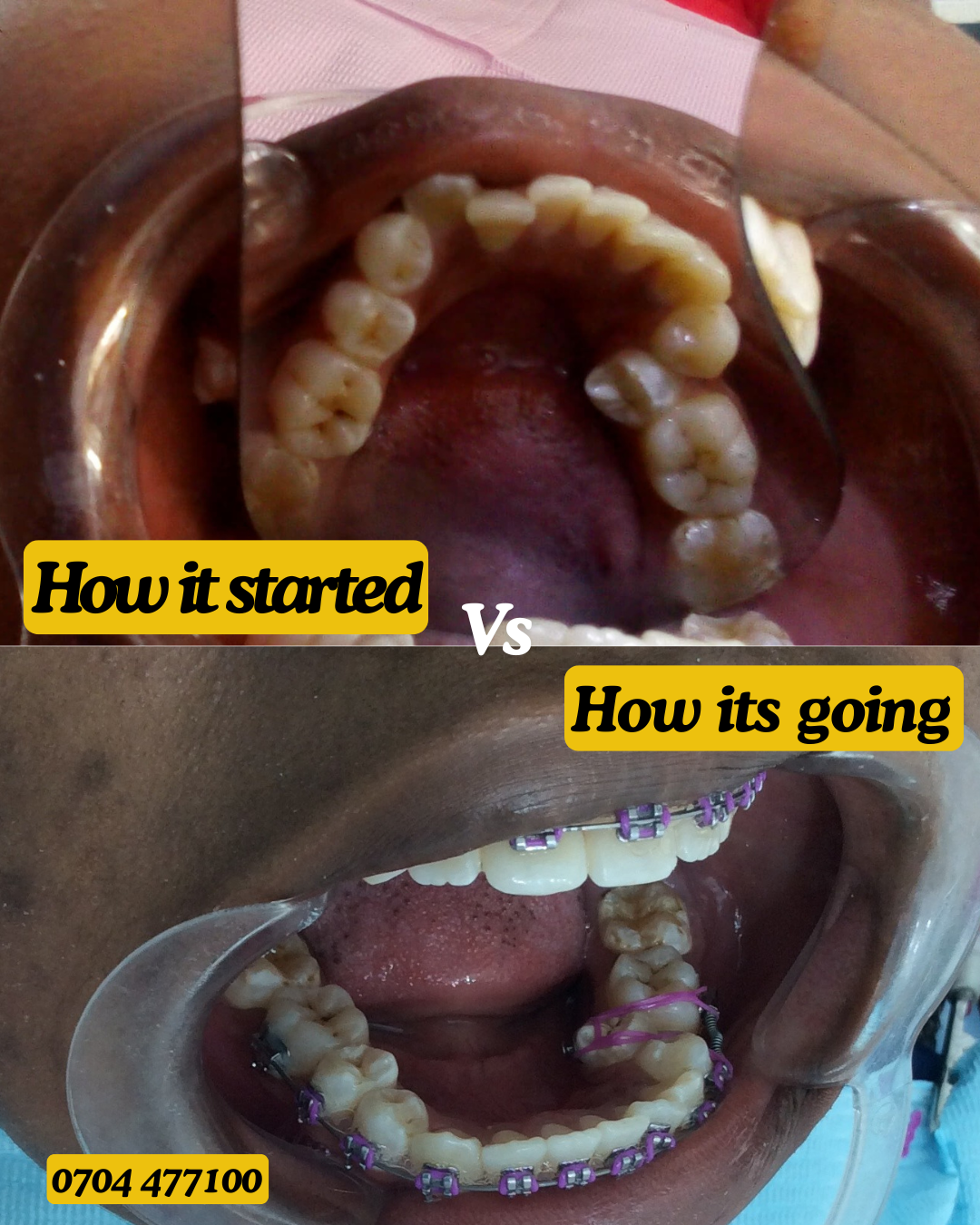 Braces transformation 3b